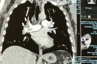 CT Scan Showing PE