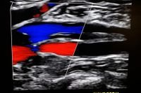 thrombosis ultrasound