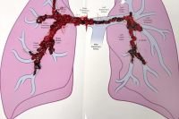 Penumbra Thrombectomy