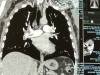 CT Scan Showing PE