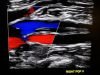 thrombosis ultrasound