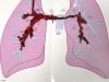 Penumbra Thrombectomy
